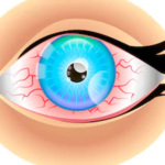 Cara Mengatasi Mata Lelah