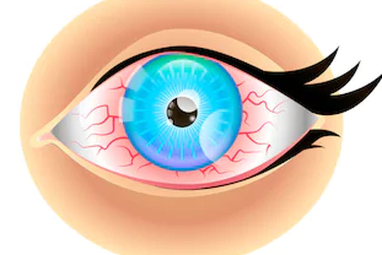 Cara Mengatasi Mata Lelah